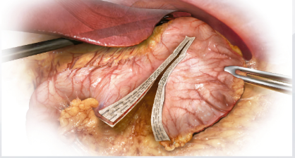 GORE® SEAMGUARD® BIOABSORBABLE